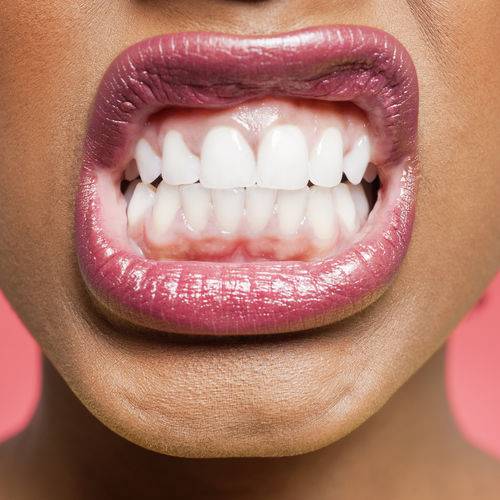 Serrer les dents : Bruxime