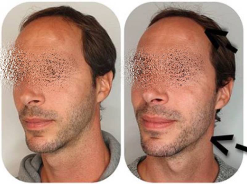 Jawline definition, injection jawline, mentoplastie médicale, fillers, jawline homme