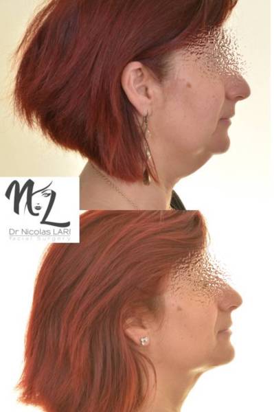 double menton marseille, opération du double menton à marseille, liposuccion double menton, résultat avant après double menton,