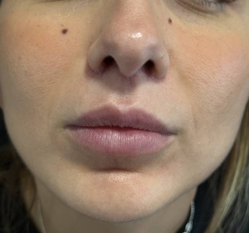 Cicatrice de lip lift ou chirurgie de raccourcissement de la levre supérieure à Marseille 