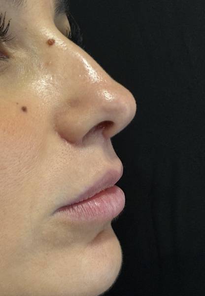 Cicatrice lifting de la levre ou lip lift cicatrice