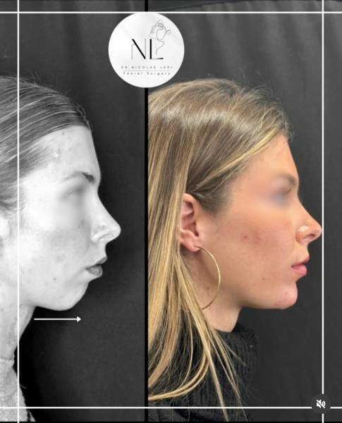 Correction d'un menton reculé par des injections du menton en acide hyaluronique