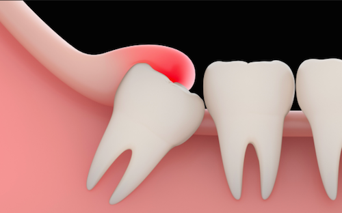 Operation dents de sagesse / Arracher dents de sagesse