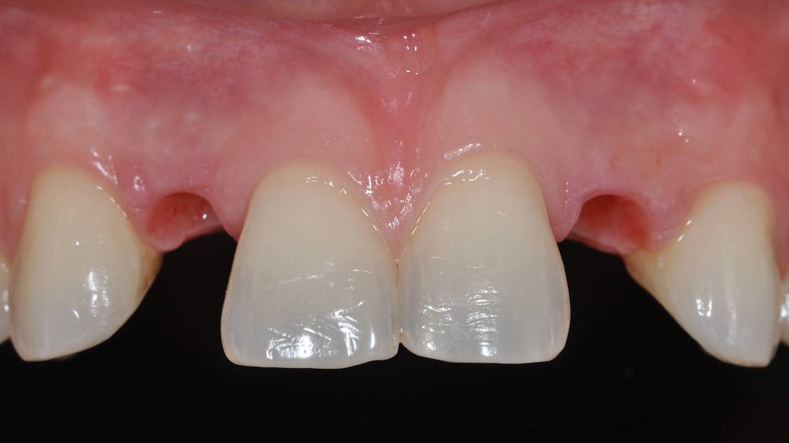 implant dentaire risques, dent manquante, changer dent implant