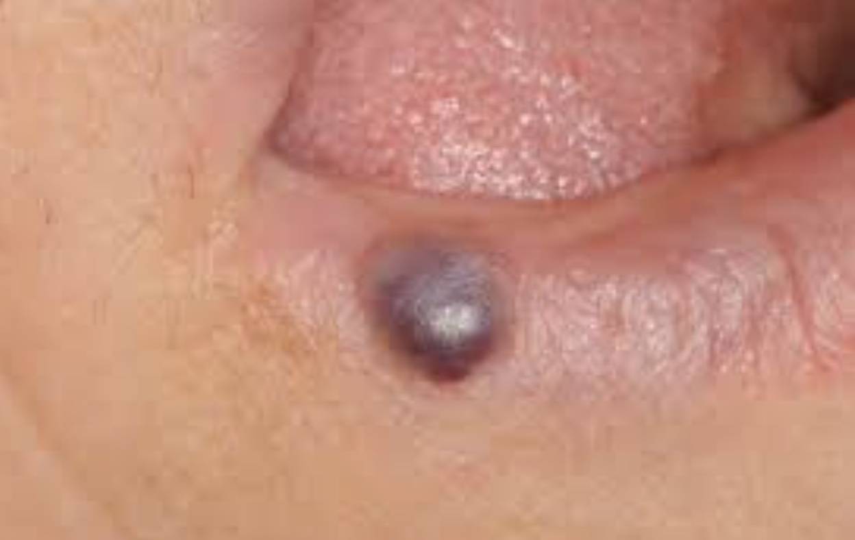 boule bleue lèvre chirurgie