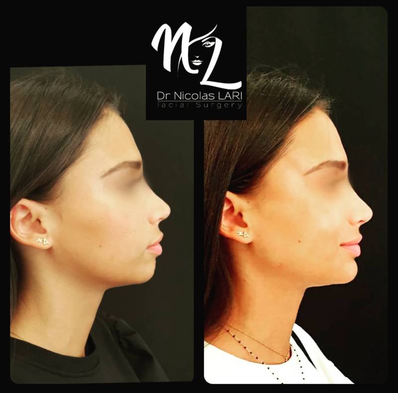 Chirurgie menton fuyant marseille par osteotomie sur mesure