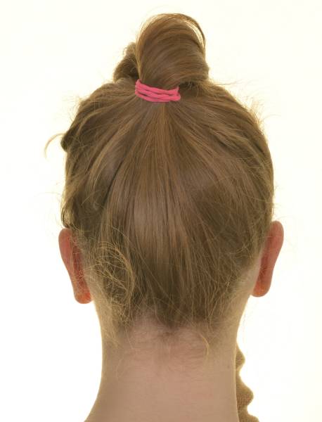 Oreilles après chirurgie d'otoplastie à Marseille 